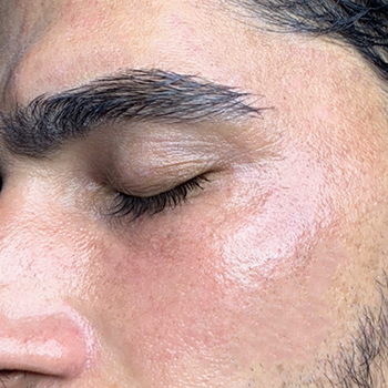 جوان سازی و درمان لک گونه - بعد