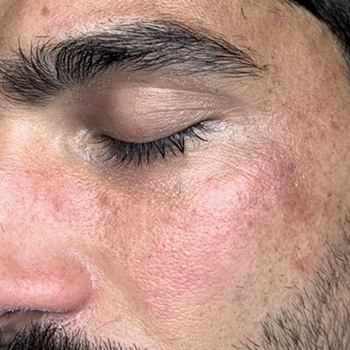 جوان سازی و درمان لک گونه - قبل