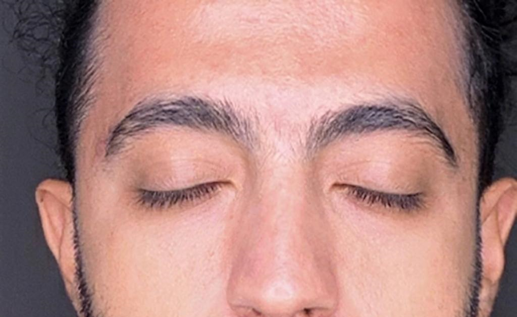 درمان جوش - بعد