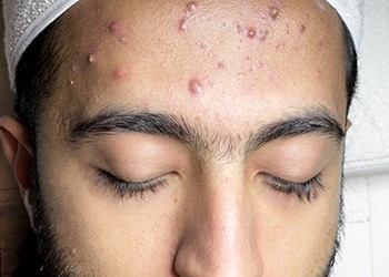 درمان جوش - قبل