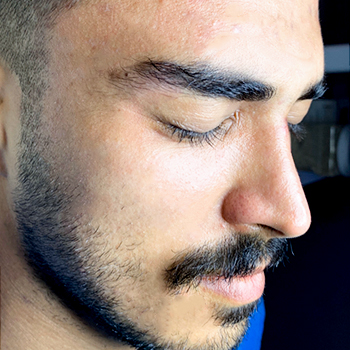 درمان لک - بعد