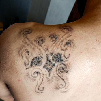 پاک کردن تتو و خالکوبی - بعد