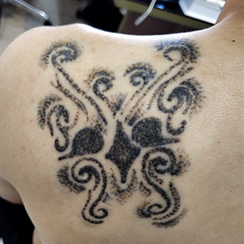 پاک کردن تتو و خالکوبی - قبل